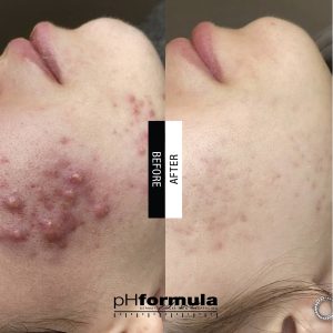 Westhoughton Acne treatment