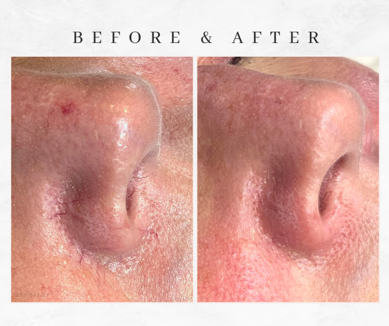 Advanced Electrolysis near bolton spider veins on nose and cheek removal