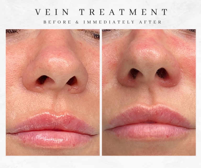 Nose Vein removal Bolton electrolysis