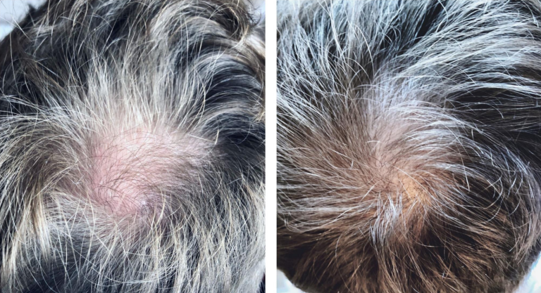 Bolton Hair loss treatment restoration