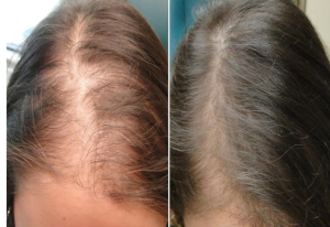 Manchester Hair Loss treatment