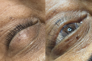 Skin Tag Removal Westhoughton