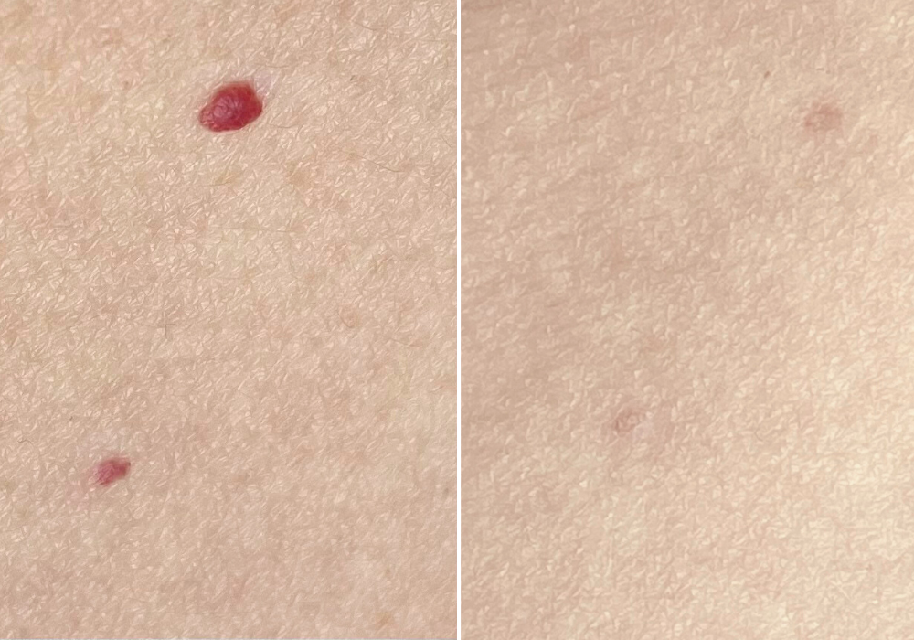 Cherry Angioma Removal - Loud Skin Clinic Westhoughton, Bolton | Hair  Removal, Skin Tag, Rosacea