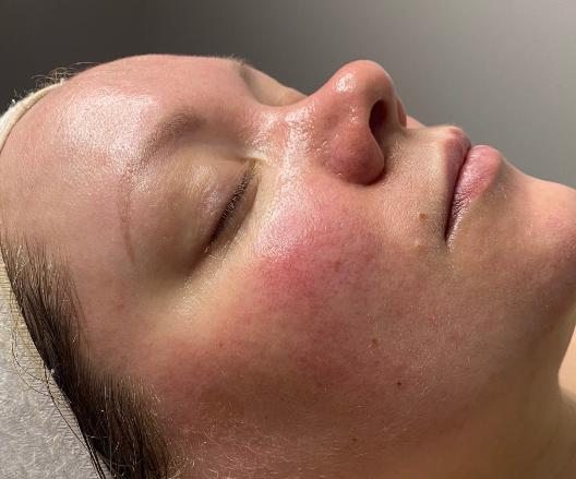 Skin Resurfacing Treatment Facials Westhoughton