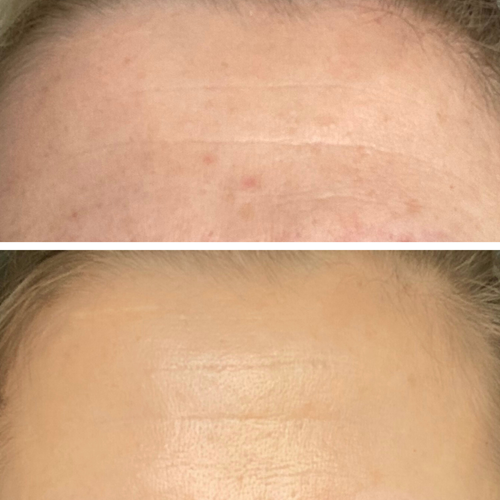 Microneedling Loud Skin Clinic Westhoughton, Bolton Advanced