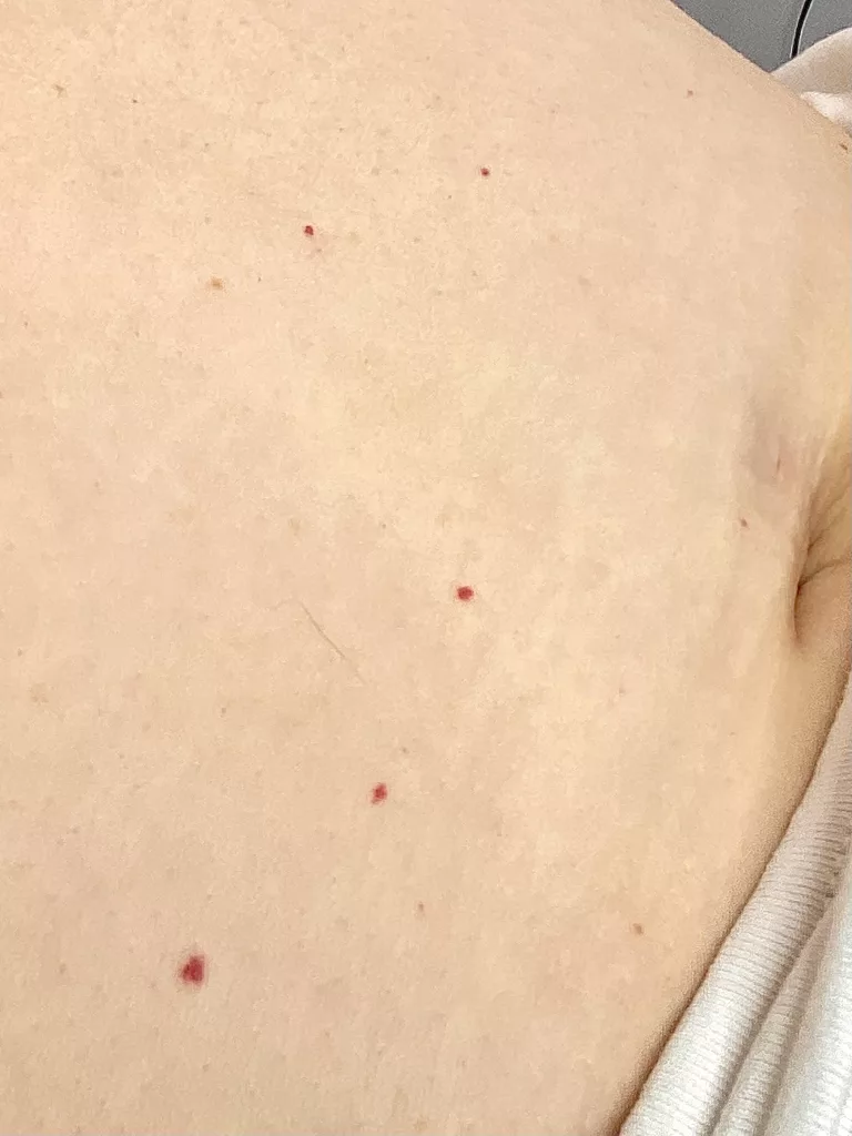 Cherry Angioma Removal Loud Skin Clinic Westhoughton, Bolton