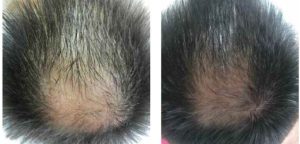 hair loss treatment mesotherapy westhoughton