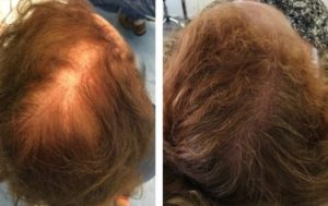 Bolton Hair loss treatment mesotherapy
