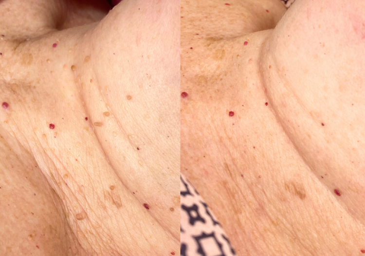 Skin Tag Removal Loud Skin Clinic Westhoughton, Bolton Advanced