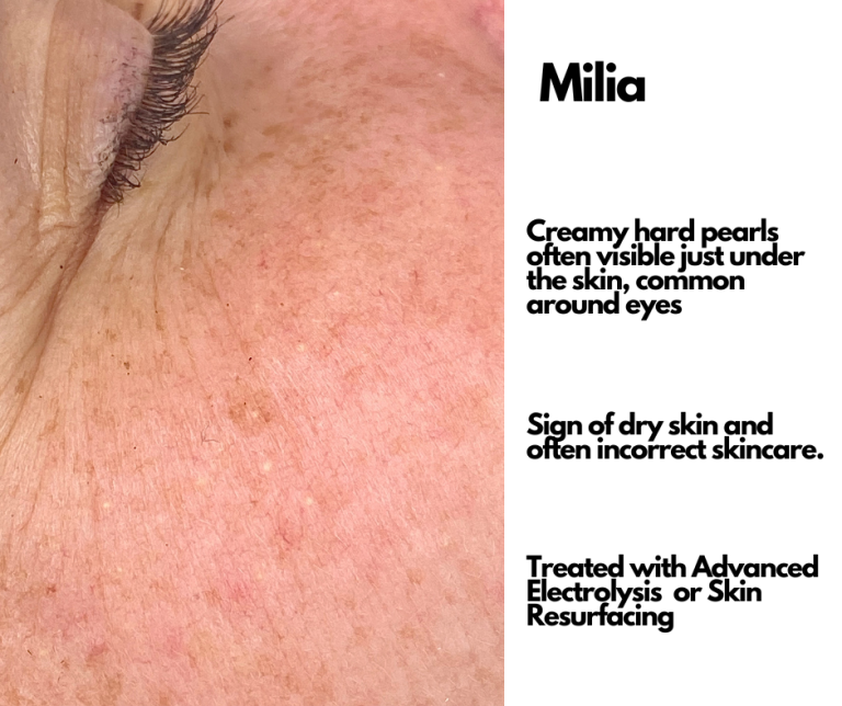 Milia Treatment - Loud Skin Clinic Westhoughton, Bolton | Advanced ...
