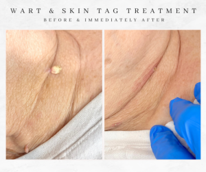 bolton skin tag removal immediately after