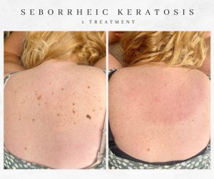seb k treatment westhoughton