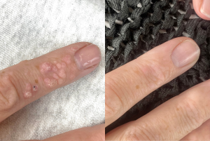 Westhoughton wart treatment hands before and after electrolysis