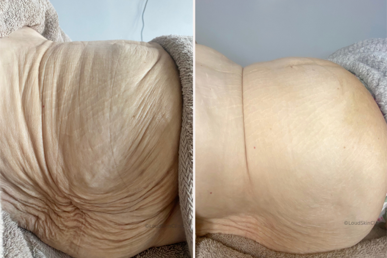 Rf Microneedling Bolton