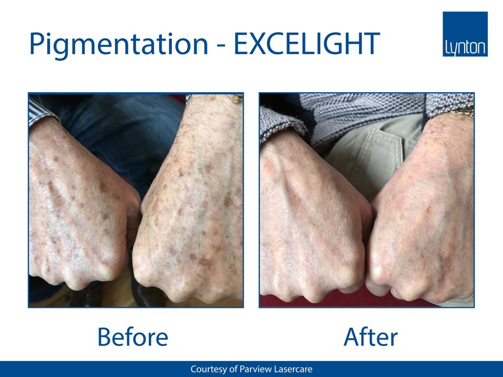 Lynton IPL Pigmentation Treatment – Skin Clinic Bolton | HIFU, RF ...