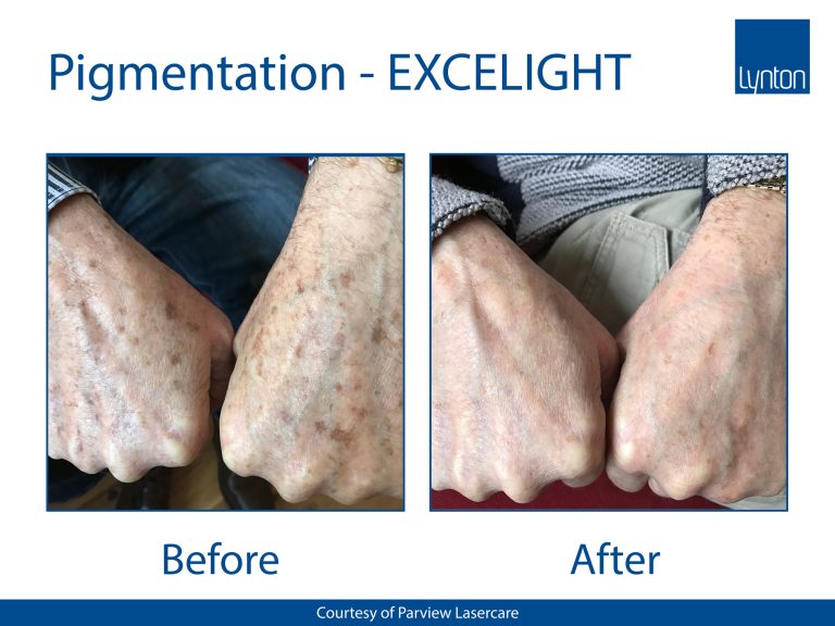 Lynton IPL Pigmentation Treatment hands