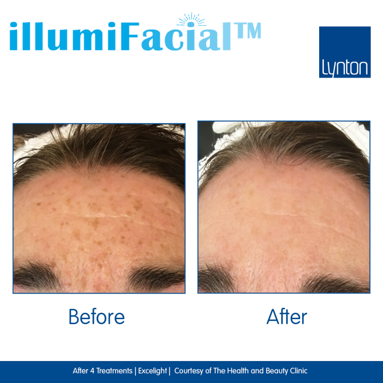 freckle treatment bolton pigmentation