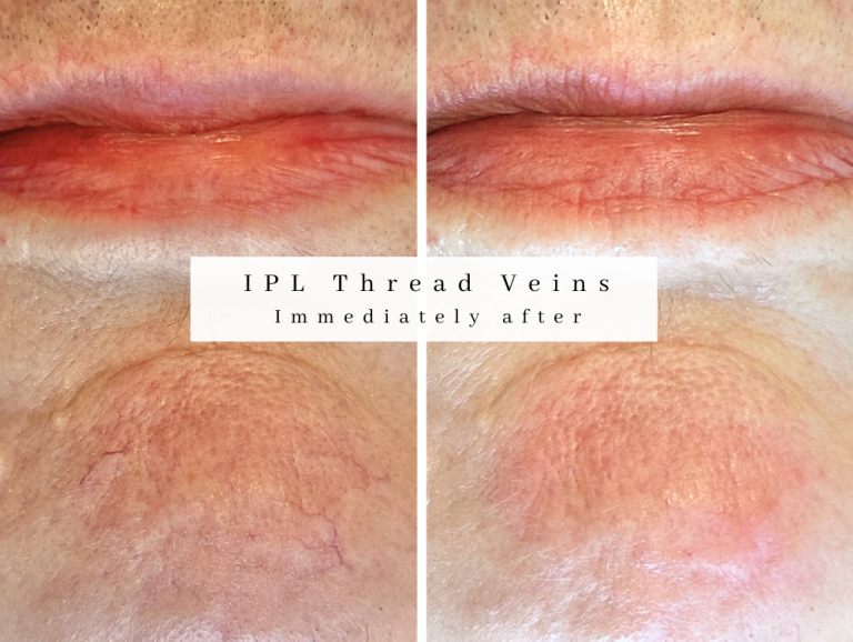 IPL Thread vein treatment Bolton