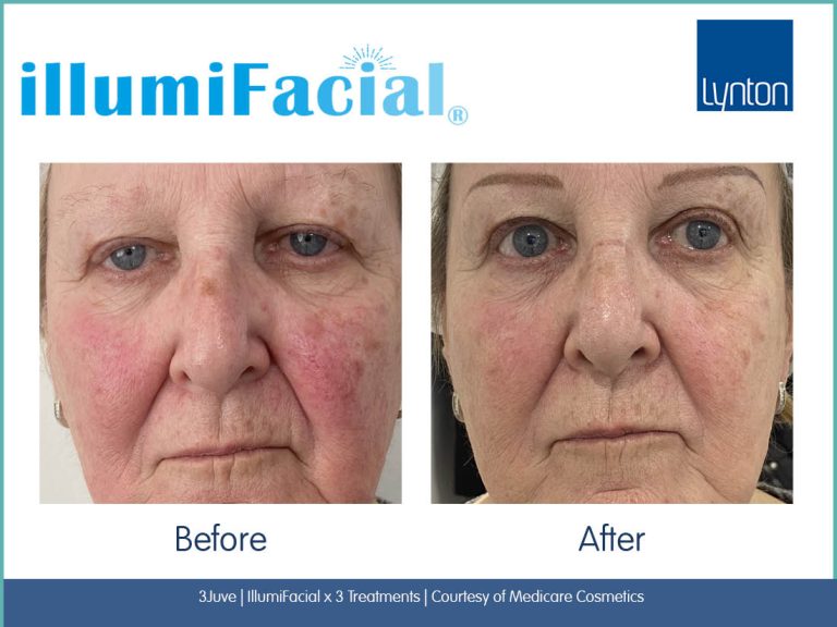 IllumiFacial Before & After bolton ipl lynton