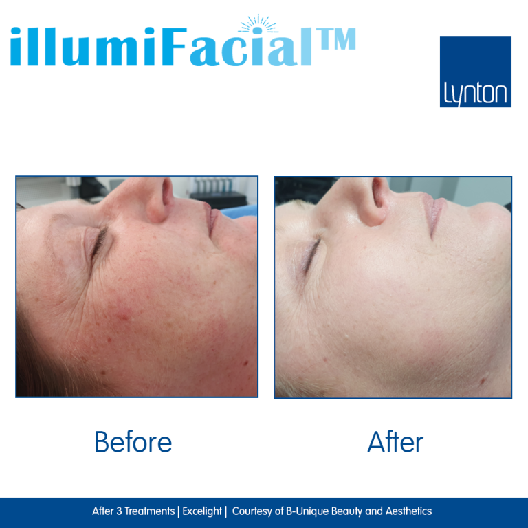 Illumifacial westhoughton bolton