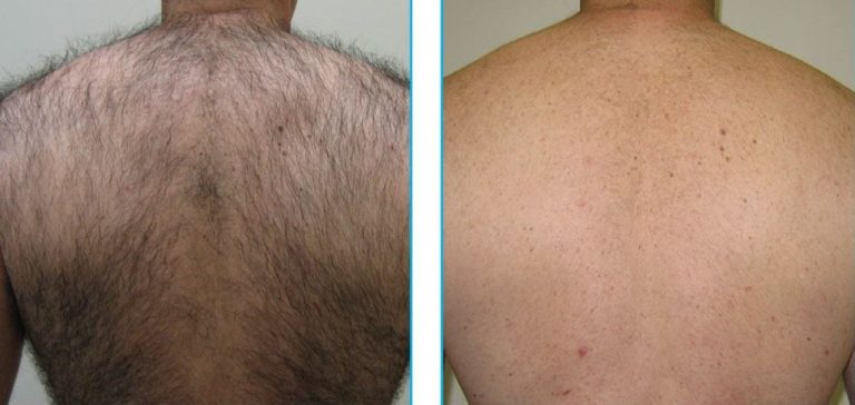 Westhoughton hair removal