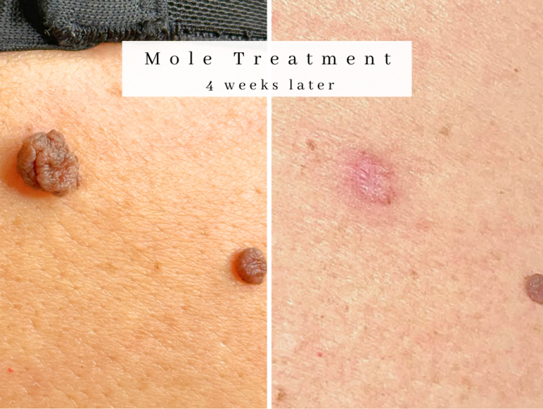 Mole Treatment westhoughton skin clinic reduction