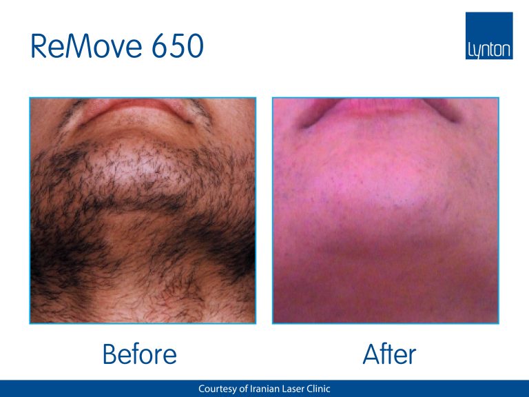 Lynton ipl Hair Removal westhoughton