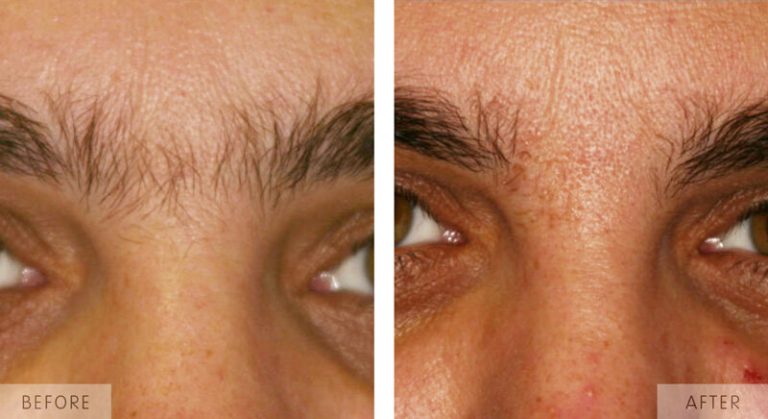 brow hair removal bolton