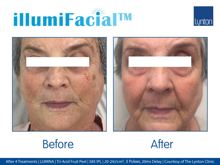 Illumifacial westhoughton bolton