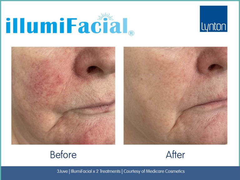 ipl Redness treatment bolton lynton clinic