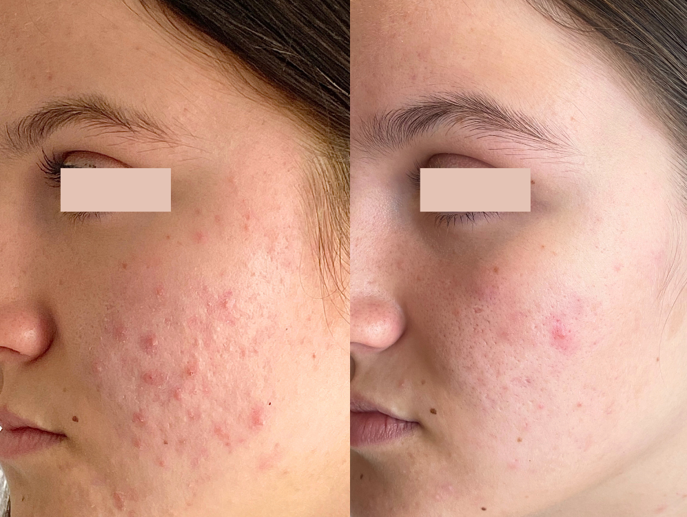 Bolton Acne treatment acne scar