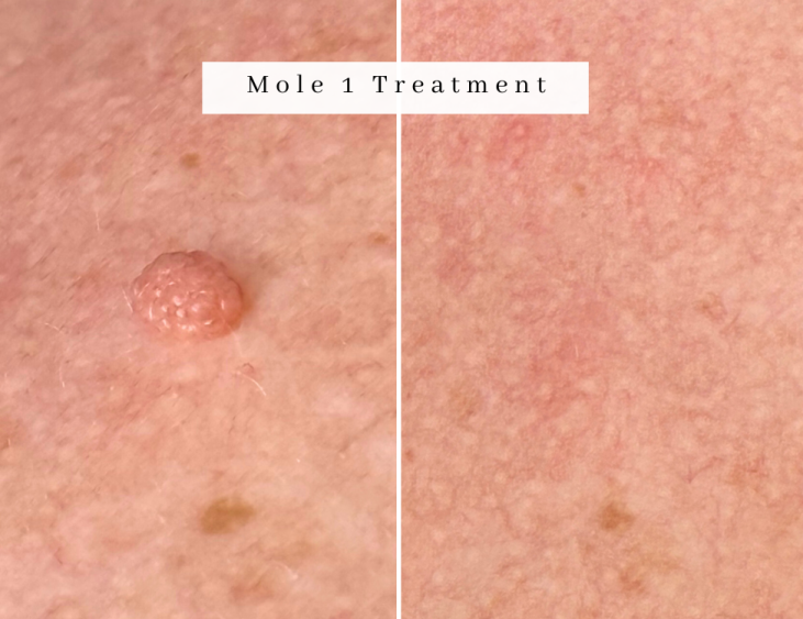Mole treatment manchester advanced electrolysis