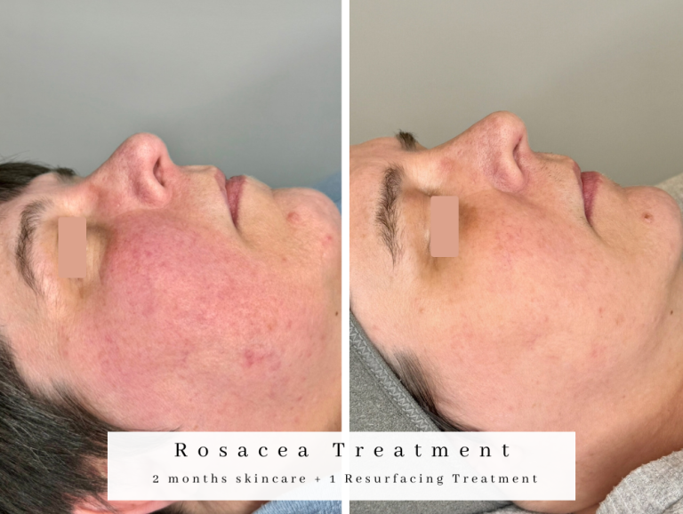 Rosacea Treatment bolton