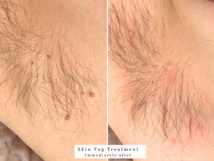 bolton skin tag removal westhoughton treatment
