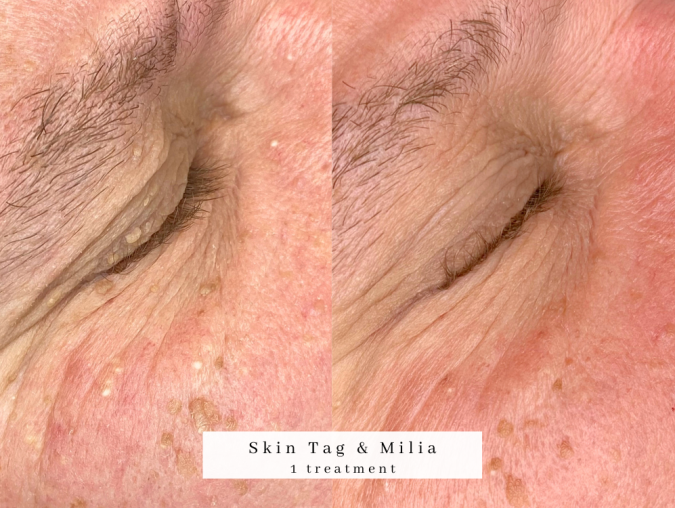 eye skin tag treatment bolton treatment