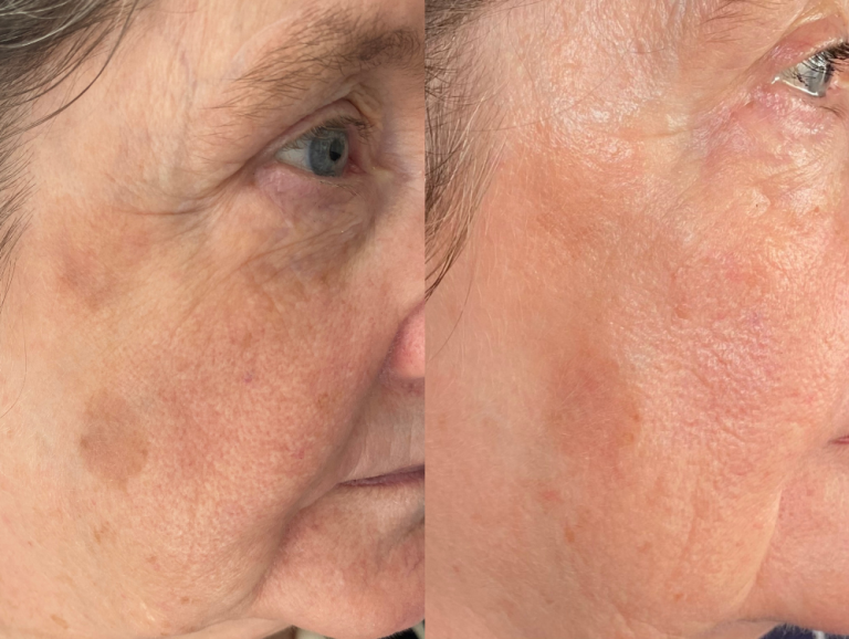rejuvenation skin treatment bolton skin clinic loud