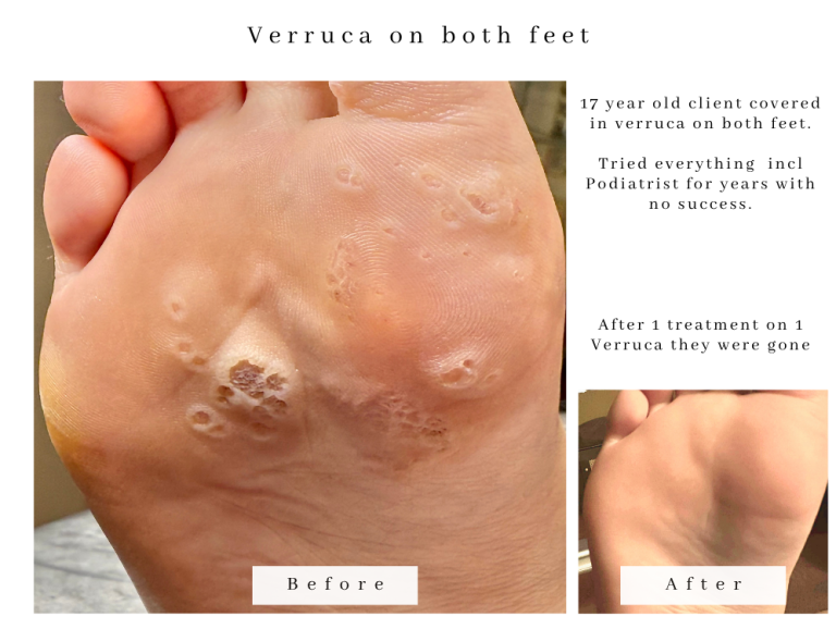 Verruca treatment bolton before and after