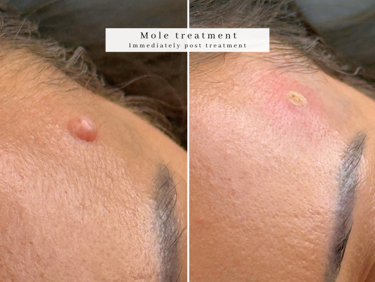 Mole treatment reduction westhoughton non surgical