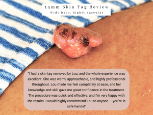 Skin Tag removal bolton skin clinic