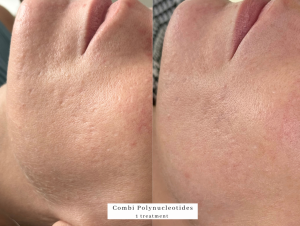 Combi polynucleotide treatment westhoughton antiageing and scar treatment