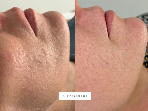 bolton polynucleotide scar treatment