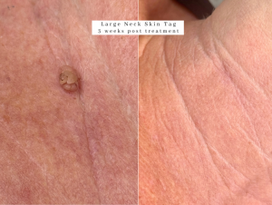 skin tag removal bolton