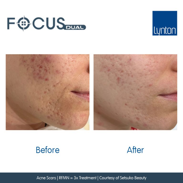 Acne scar treatment westhoughton