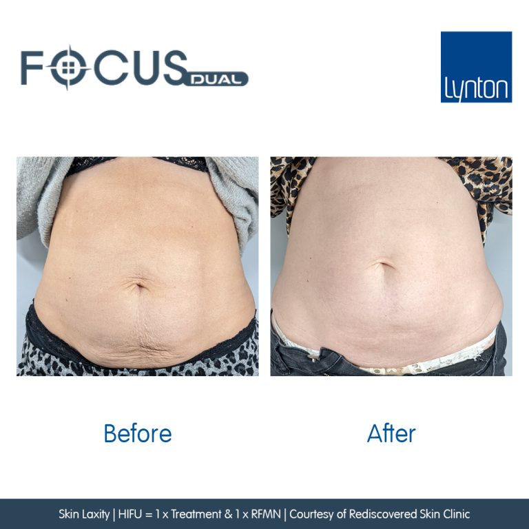 skin Stomach tightening westhoughton Before and After. Focus Dual. Skin Laxity. HIFU&RFM.