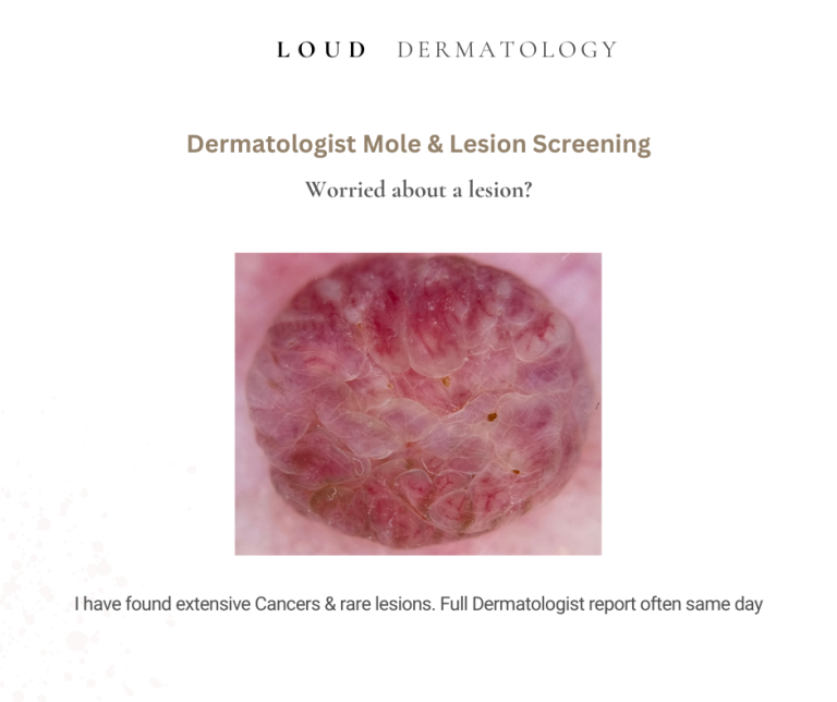 Westhoughton Dermatologist mole screening