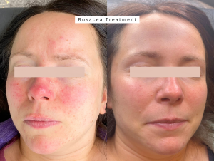 Bolton Rosacea Treatment Loud Skin Clinic Westhoughton