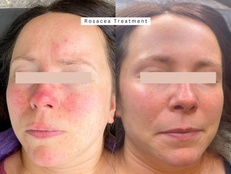Bolton Rosacea Treatment Loud Skin Clinic Westhoughton