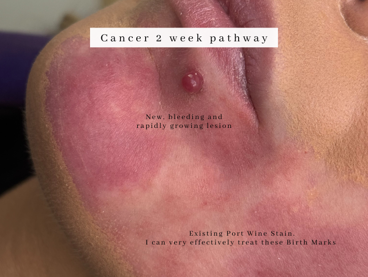 Dermatologist westhoughton lesion check