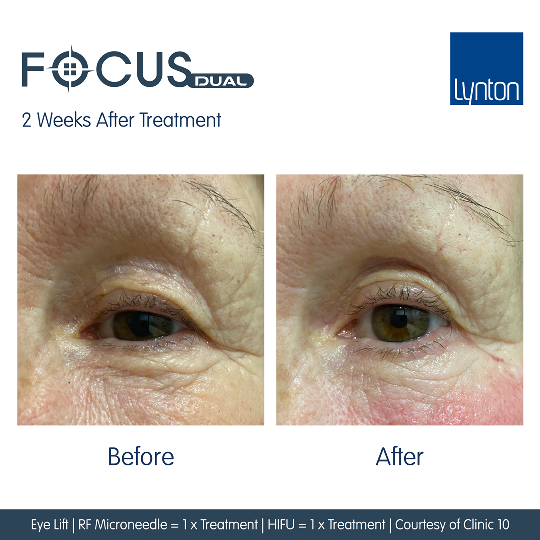 Eye Lift - Bhleroplasty non surgical treatment eye bags 1 RF Microneedling Treatments
