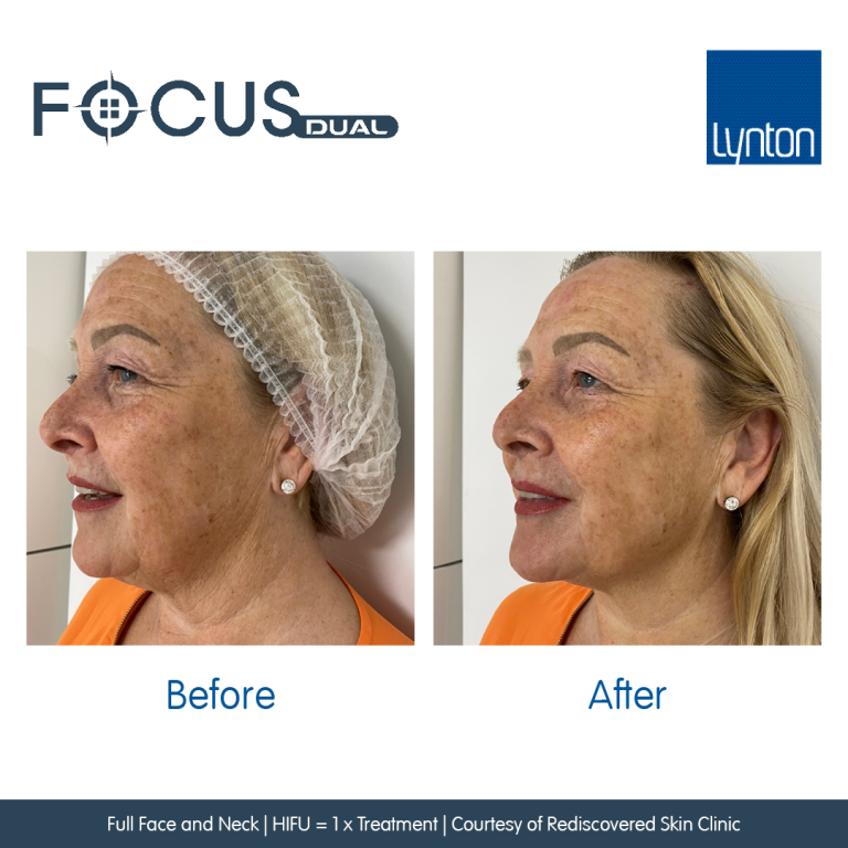 Hifu Treatment westhoughton